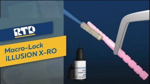 Macro-Lock iLLUSION X-RO | Кварцевые стекловолоконные штифты | Инструкция установки