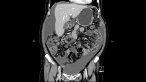 Памяти Михаила. Рак желудка - история настоящего Богатыря