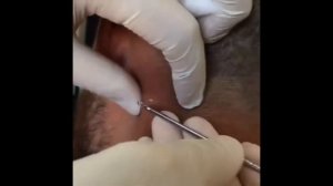 Relax Every Day 🔥Самое залипательное видео давить прыщи Dermatologist.video to press pimples АКНЕ 2