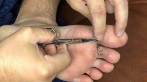 Как снять швы самому себе после пореза. Как самому снять швы. Кака снять швы видео. Снять шов нога