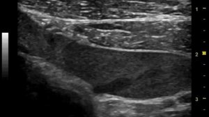 ПОДКЛЮЧИЧНАЯ ВЕНА. ВЕНОЗНЫЙ СТАЗ