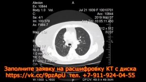 Аксиальная ГРЫЖА ПИЩЕВОДНОГО ОТВЕРСТИЯ диафрагмы на заключении КТ грудной клетки.  Постоянная изжог