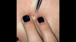 Relax Every Day 🔥Самое залипательное видео давить прыщи Dermatologist.video to press pimples АCNE
