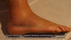 Вывих щиколотки