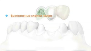 Что такое безметалловая керамическая коронка зуба