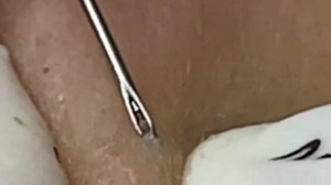 удаление черных точек #829