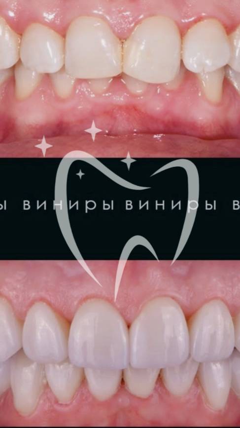 Виниры: секрет голливудской улыбки