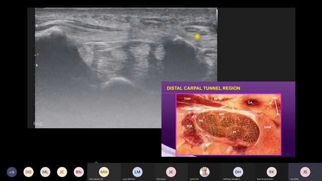 Carpal Tunnel with Dr. Jay Smith | AMSSM Sports Ultrasound Case Presentation смотреть онлайн
