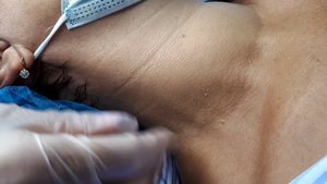 Удаление папиллом на шее