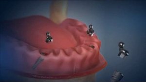 5. Угловой шаровидный абатмент