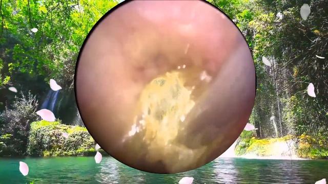 Удаление гигантского куска серы из уха | Гигантская серная пробкаЭндоскопическое лечение ушей смотреть онлайн