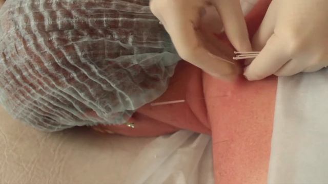 Иглоукалывание шея