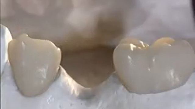 Мостовидные протезы, предпосылки.flv смотреть онлайн