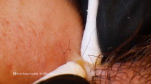 Gebhard & The Q-Tips (Deep Blackheads Around The Lips)