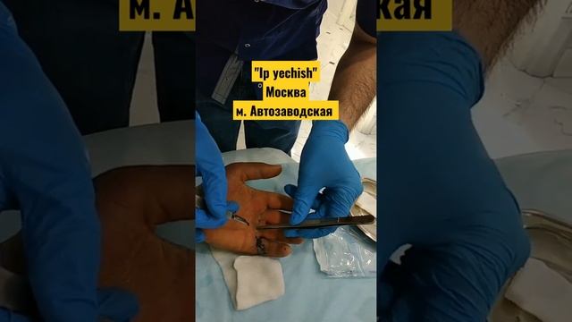 1.Снятия швов с раны 2.Ip yechish #handsurgery