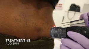 GOODBYE Tramp Stamp! LASER TATTOO REMOVAL on Dark Skin| LaserAway