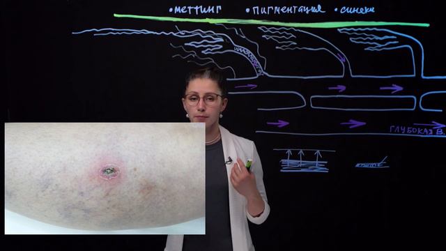Осложнения склеротерапии
