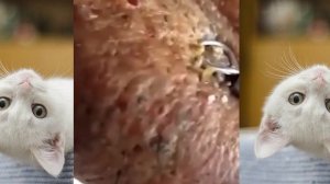 粉刺 粟粒腫 Самое залипательное видео давить прыщи Черные точки Dermatologist video to press pimples