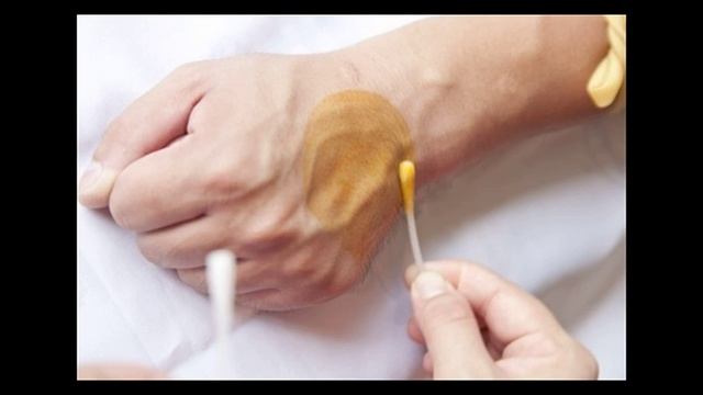 Три варианта теста на определение уровня йода в организме. смотреть онлайн