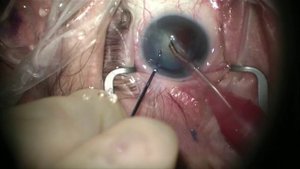 LSU Resident White cat post myopic lasik ORA