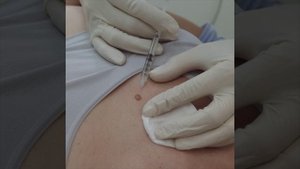 Удаление родинки радиоволной