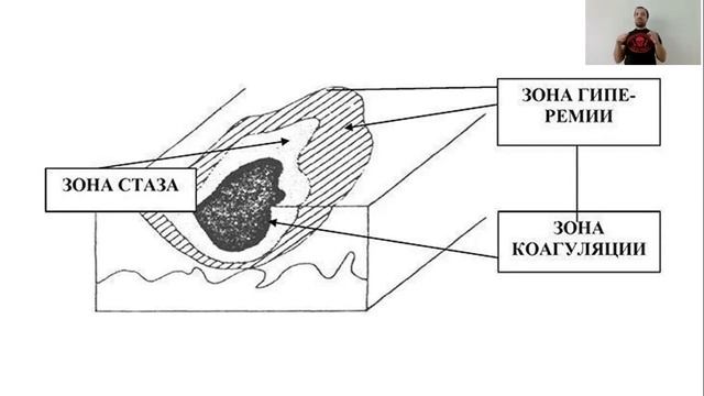 Ожоги. Вебинар от 10.05.2020. Часть 1. смотреть онлайн