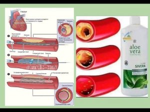 LR : ишемия и стены - повысить благоприятный исход.