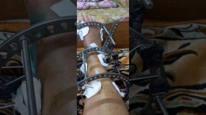 перелом таранной кости.  Замена и прием лекарств после выписки. 2