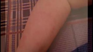 Сыпь в виде комариных укусов