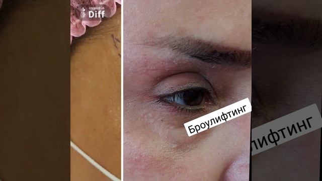 #броулифтинг #морщины через 2 месяца смотреть онлайн
