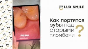 Как портятся зубы под пломбой?