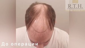 Отзыв американца Роберта через 8 месяцев после пересадки волос☀️