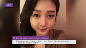 Подтяжка шеи до и после операция в Корее (JW plastic surgery)