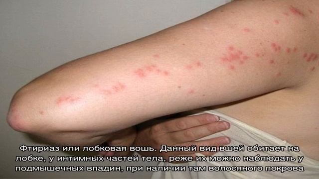 Как выглядят укусы вшей на голове