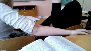 Сломанная рука! ШОК! ПЕРЕЛОМ В ЛОКТЕ СО СМЕЩЕНИЕМ! В ШКОЛЕ!