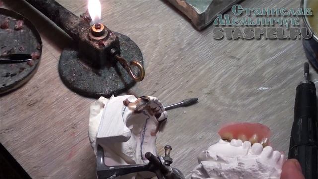 ЗУБНОЙ ПРОТЕЗ. Коронки с выраженным экватором. Продолжение - Подготовка к перебазировке протеза