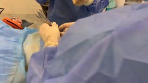 Mons pubis lifting. Mons pubis plasty in women. Подтяжка лобка. Пластика лобка у женщин.