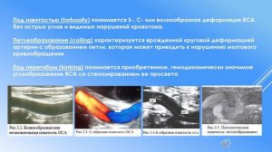 Выпуск 14 Классификация извитостей сонных артерий