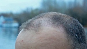 Приживаемость волос после пересадки. Ждал 2,5 месяца результата. Рост новых волос по осени.