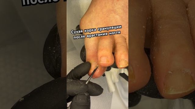 Сухая корка на грануляции в боковом валике #мозоли #подология