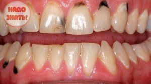 Почему чернеют зубы у взрослых?