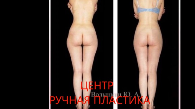 Как уменьшить бедра и ягодицы Фото До и После  Ручная пластика