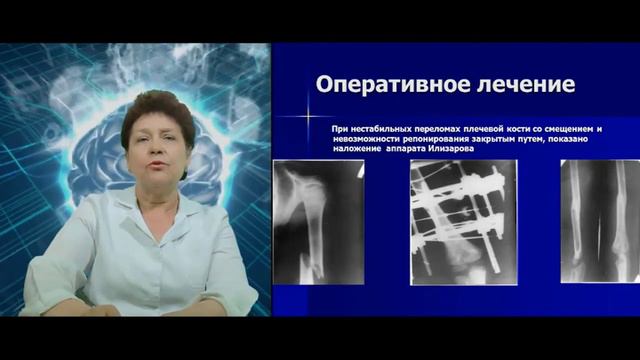 Переломы костей верхней конечности