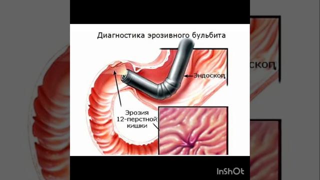 Язва желудка и двенадцатиперстной кишки смотреть онлайн
