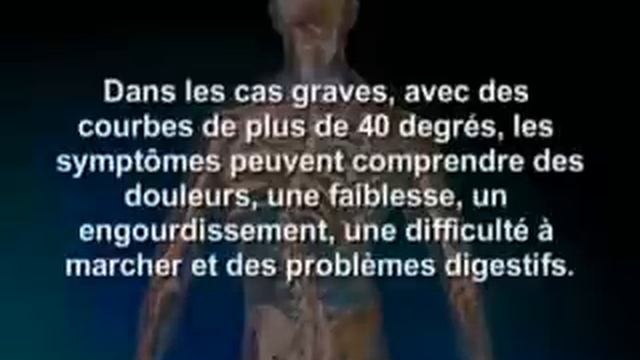 La Scoliose Vue en 3D : Méthodes Pour Soulager le Mal de Dos смотреть онлайн