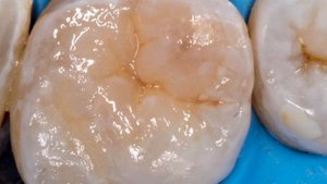 Прямая композитная  реставрация зуба , поставить пломбу  #стоматология #кариес #пломба #имплант