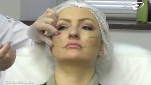 Контурная пластика. Princess Filler