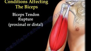 Biceps Tendon Pathology - Everything You Need To Know - Dr. Nabil Ebraheim