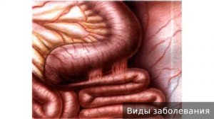 Илеус. Как лечить илеус. Как лечить кишечную непроходимость.