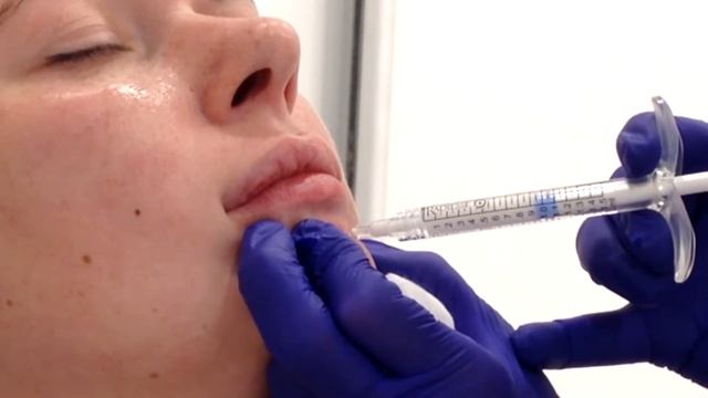Устраняем дефект в области ПОДБОРОДОЧНОЙ мышцы и участка под НИЖНЕЙ ГУБОЙ плотный филлером.
